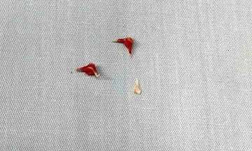 7-month-old on ventilator after eel bone lodged deep in airway