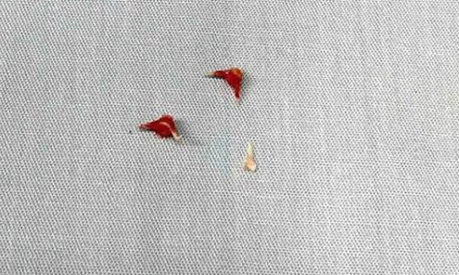 7-month-old on ventilator after eel bone lodged deep in airway