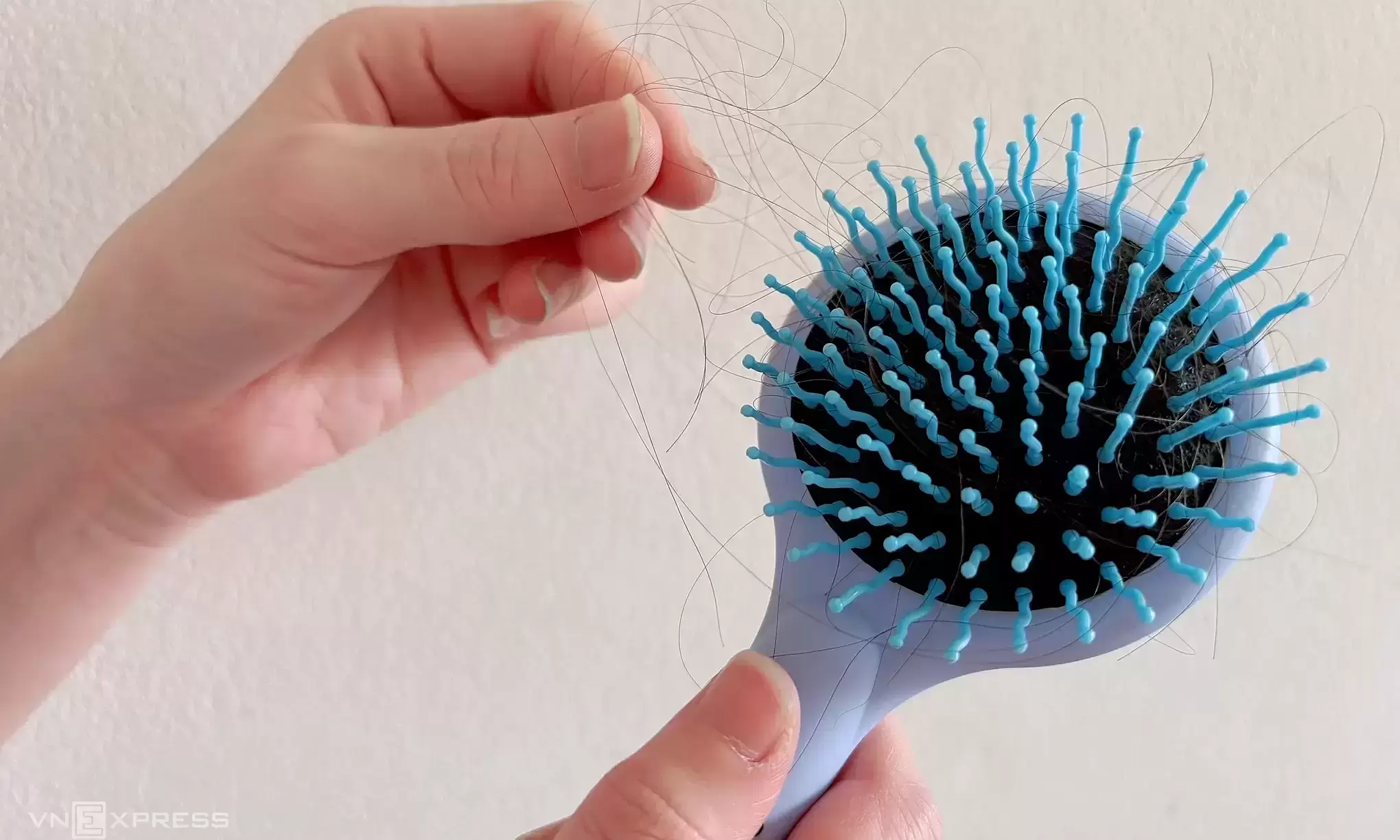 What nutrient deficiencies cause significant hair loss?