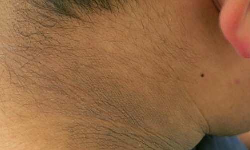 Five less-noticed signs of diabetes
