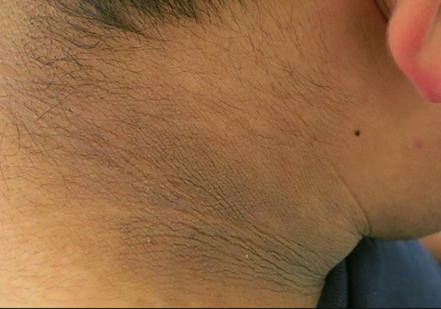 Five less-noticed signs of diabetes
