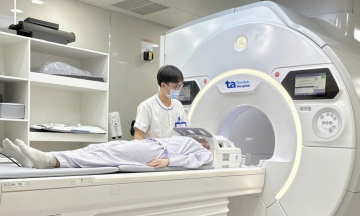 When do people under 45 need stroke screening?