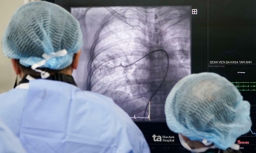 Three balloon angioplasties save woman with pulmonary artery obstruction