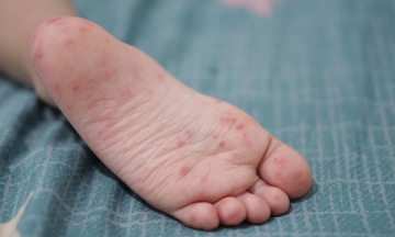 Is a second hand, foot, and mouth disease infection less severe than the first?
