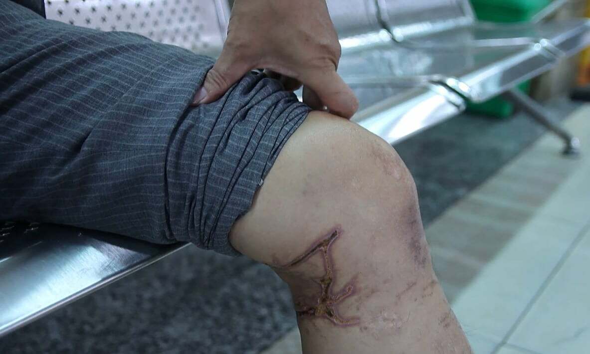Do jellyfish stings require a tetanus shot?
