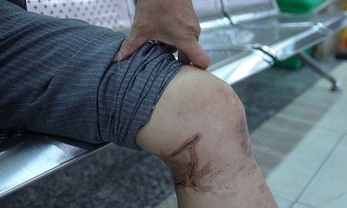 Do jellyfish stings require a tetanus shot?