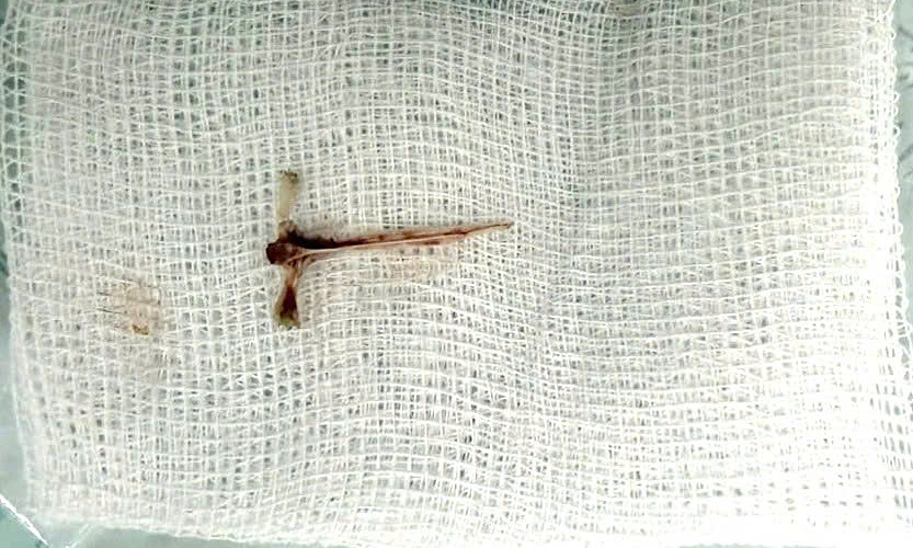 Woman coughs violently for 30 minutes due to fish bone in airway