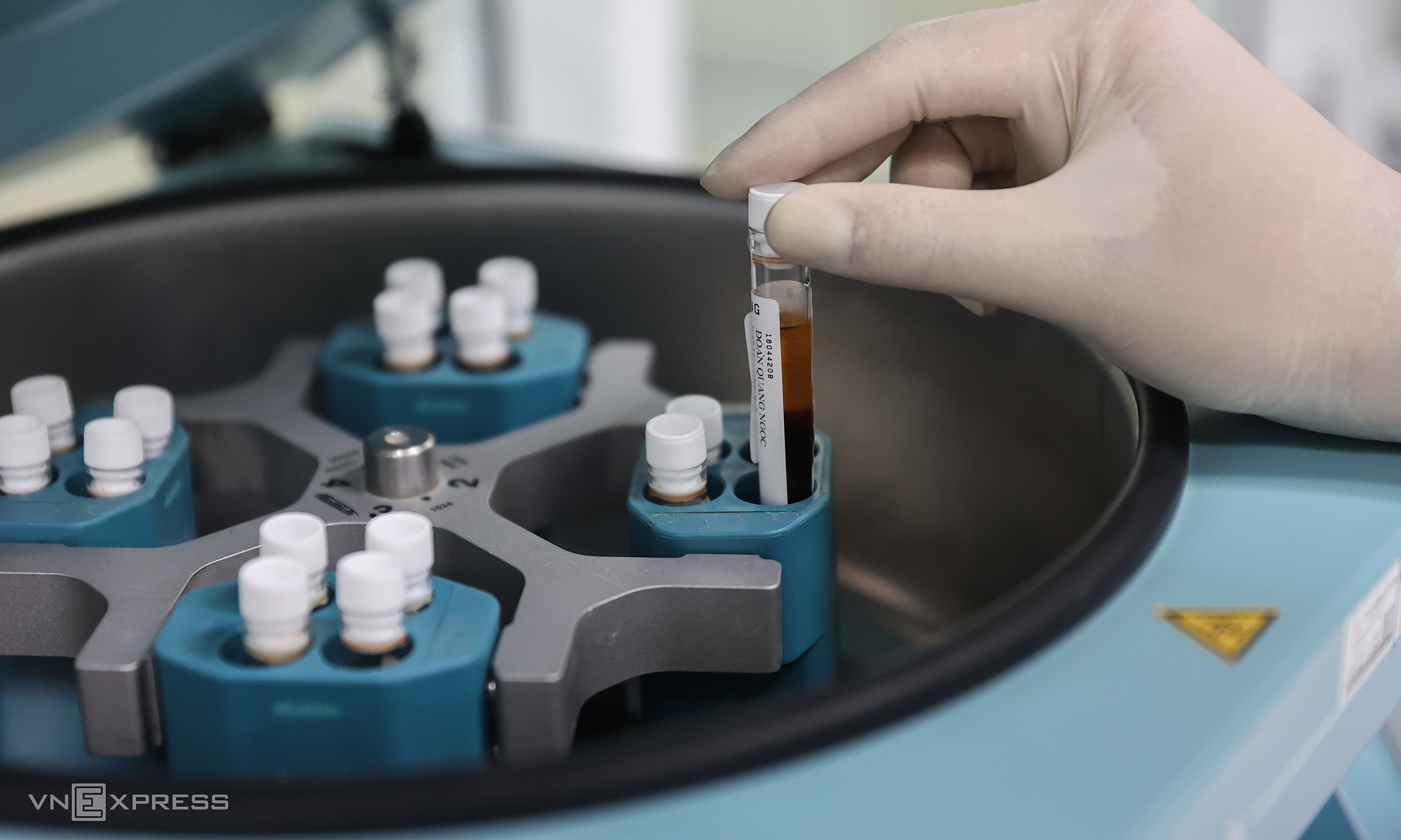 Blurred vision, acute kidney failure after drinking alcohol