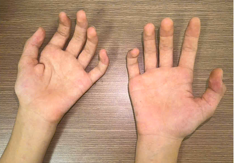 Teenager's hand muscle atrophy linked to neurological condition in young men