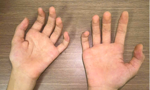 Teenager's hand muscle atrophy linked to neurological condition in young men