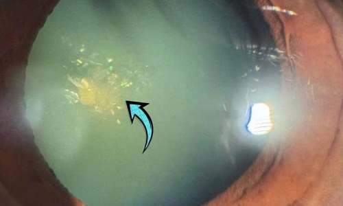 Sparkling 'christmas tree' crystals found in woman's eye