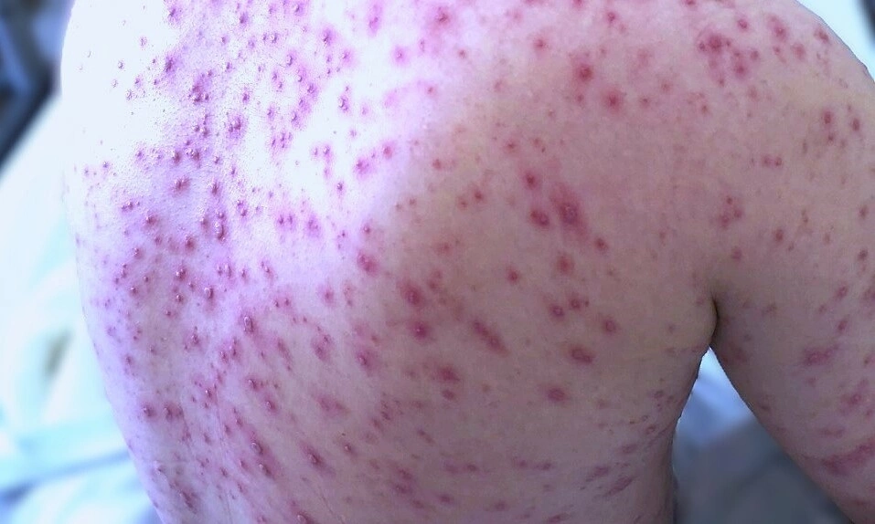 Is it true that chickenpox blisters can number up to 500?