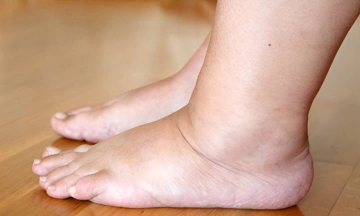 US doctor identifies five foot signs warning of kidney failure