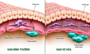 Simple ways to reduce high liver enzymes