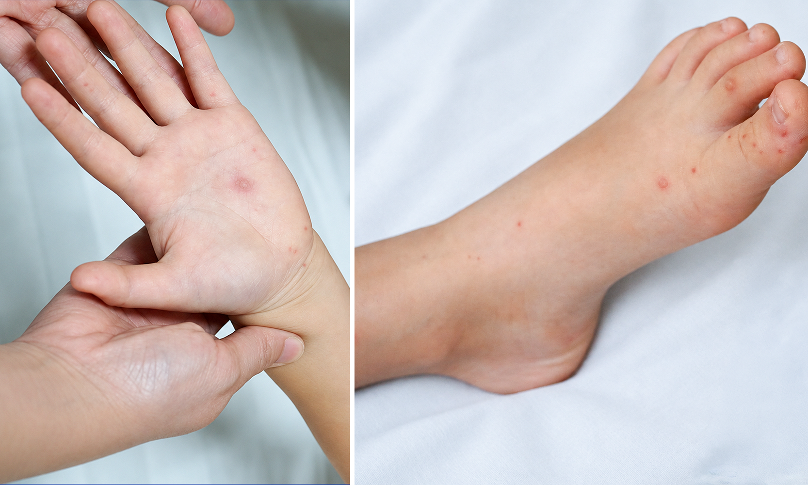 Girl diagnosed with hand, foot, and mouth disease