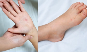 Girl diagnosed with hand, foot, and mouth disease