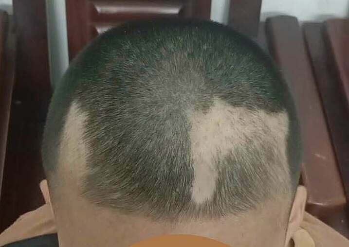 12-year-old boy pulls out patches of hair due to exam stress