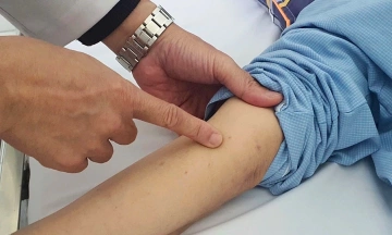 Immunity gap leaves adolescents vulnerable to meningococcal disease