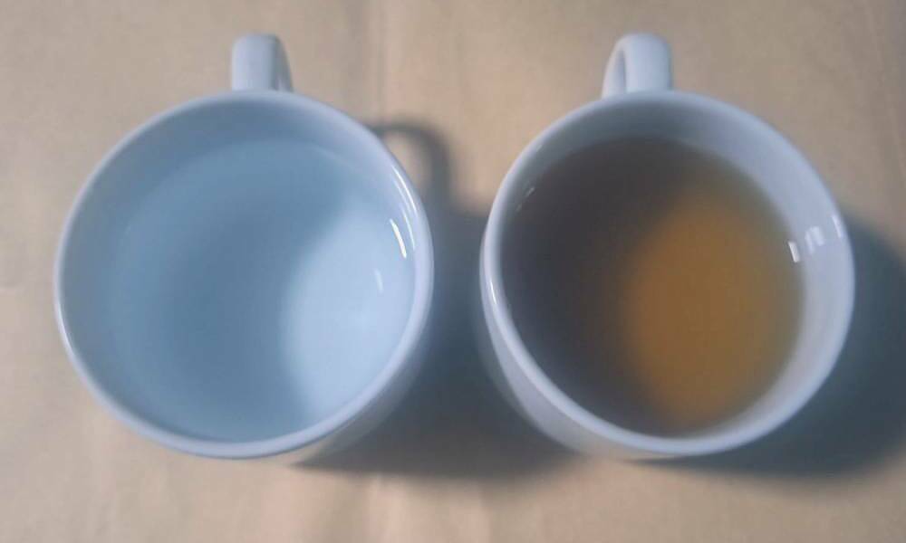Acute kidney failure from decades of drinking strong tea instead of water