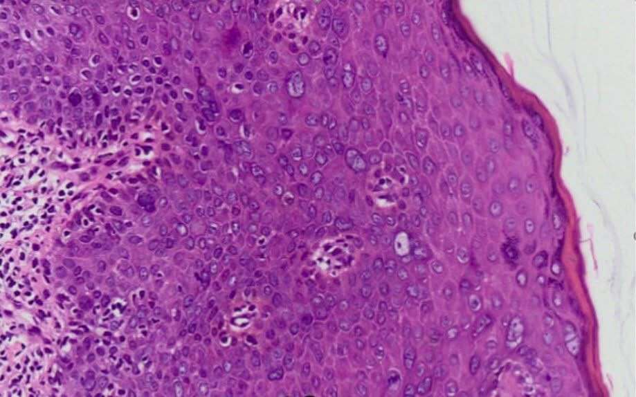 Penile cancer diagnosed after one year of unprotected sex