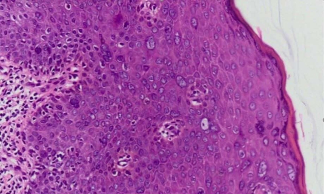 Penile cancer diagnosed after one year of unprotected sex