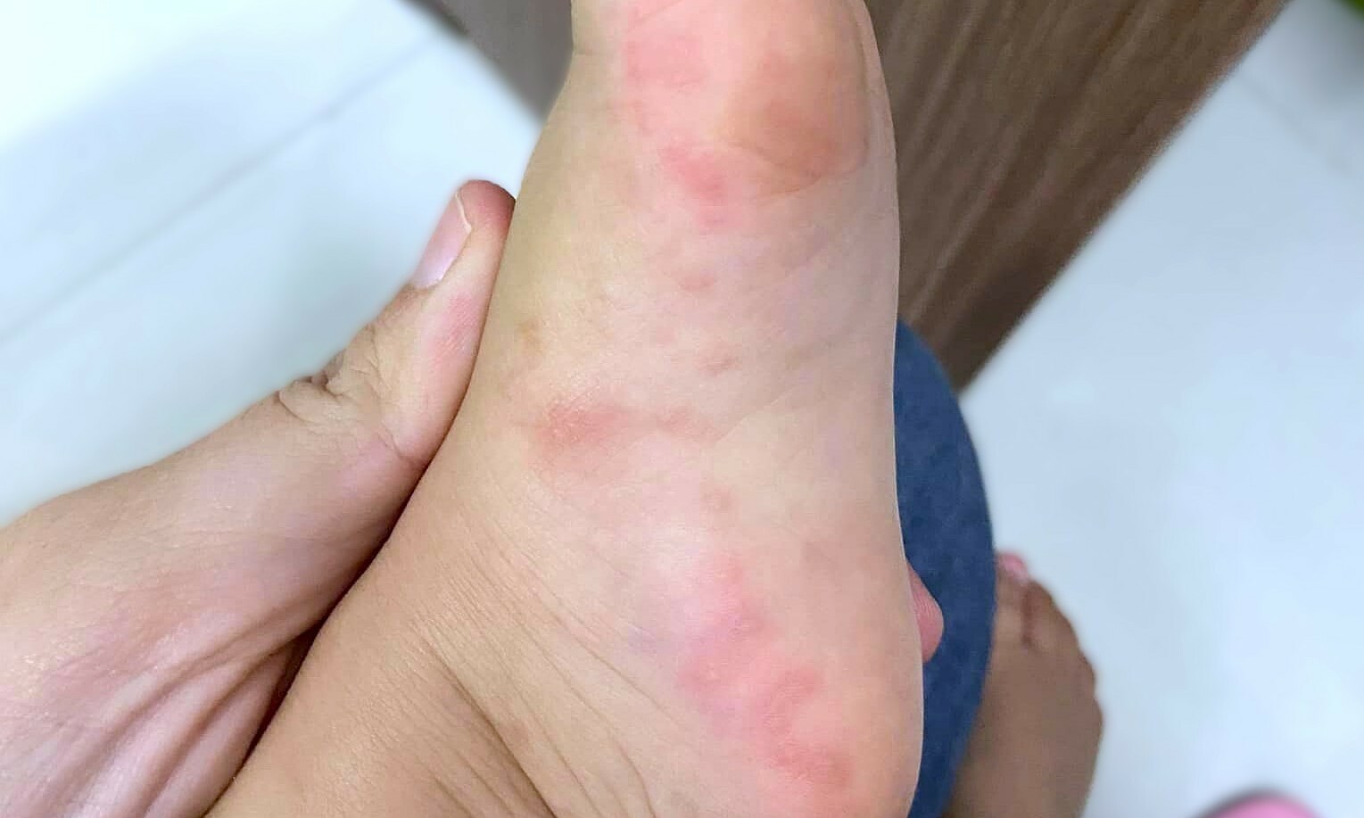 How long until children reinfect after recovering from hand, foot, and mouth disease?