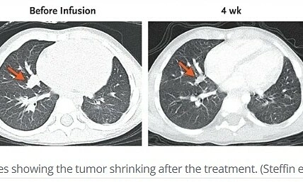 Three-year-old achieves remission from metastatic liver cancer after two immune cell infusions