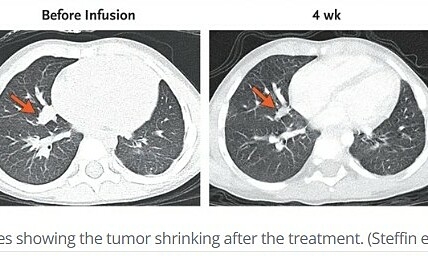 Three-year-old achieves remission from metastatic liver cancer after two immune cell infusions