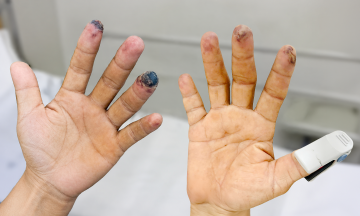Fingertip necrosis caused by thromboangiitis obliterans