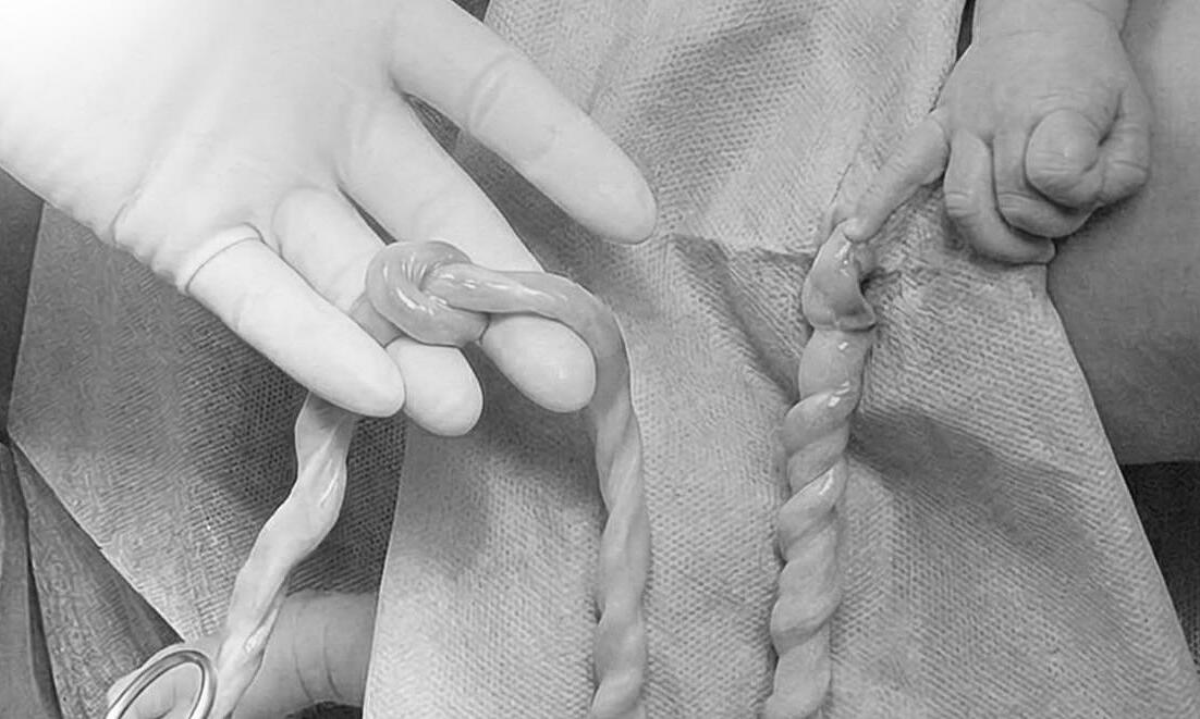 Using computer algorithms to monitor fetuses with true umbilical cord knots