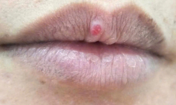 Lip abrasion transforms into pyogenic granuloma
