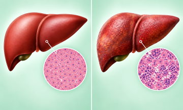 Are elevated liver enzymes a sign of fatty liver disease?