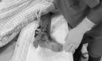 Boy's severed hand temporarily grafted onto leg after gate collapse