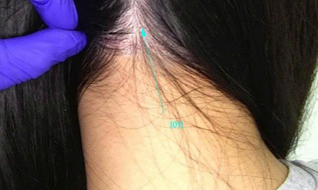 White scalp flakes due to chronic dermatitis