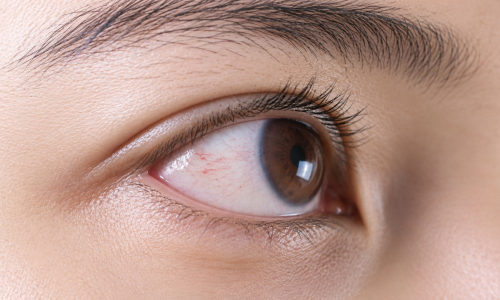 What to do when blood vessels appear on the white of the eye?